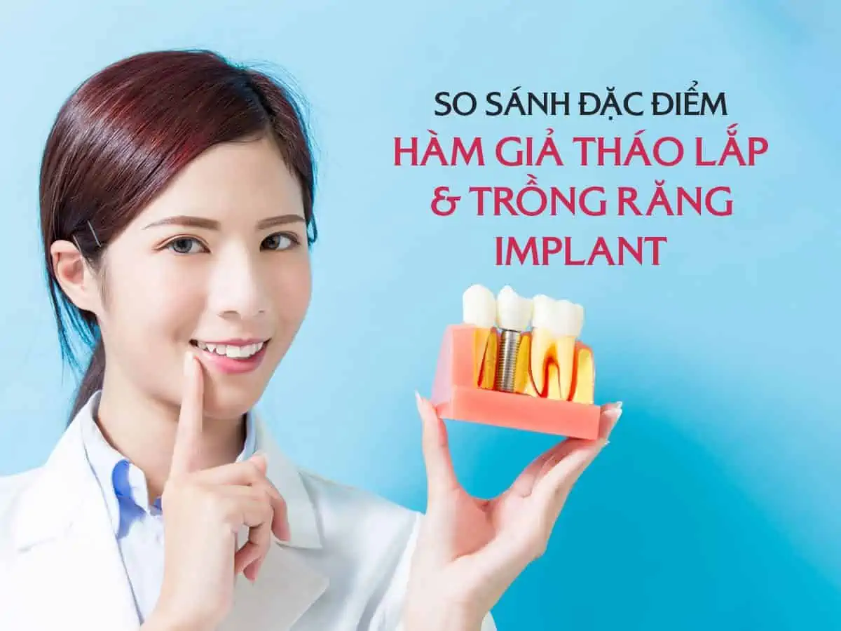 So sánh đặc điểm hàm giả tháo lắp và trồng răng Implant